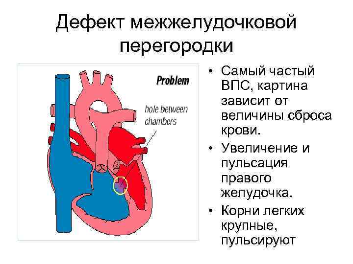 Дефект межжелудочковой перегородки • Самый частый ВПС, картина зависит от величины сброса крови. •