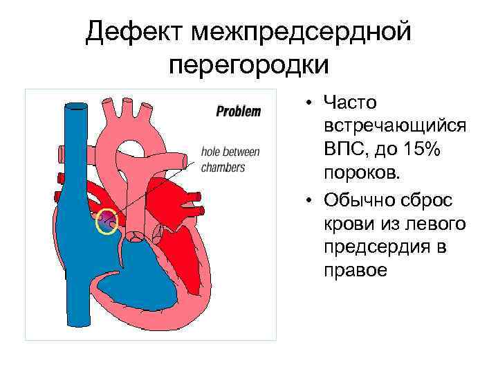 Дефект межпредсердной перегородки • Часто встречающийся ВПС, до 15% пороков. • Обычно сброс крови