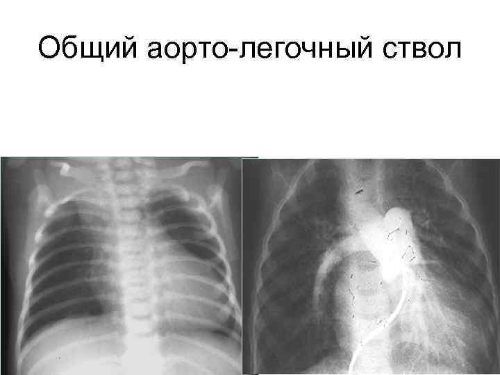 Общий аорто-легочный ствол 
