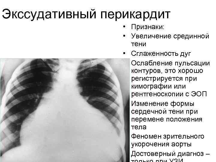 Экссудативный перикардит • Признаки: • Увеличение срединной тени • Сглаженность дуг • Ослабление пульсации