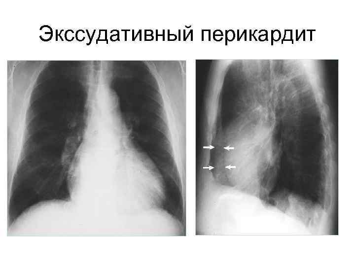 Экссудативный перикардит 