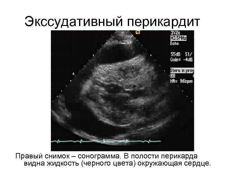 Экссудативный перикардит Правый снимок – сонограмма. В полости перикарда видна жидкость (черного цвета) окружающая