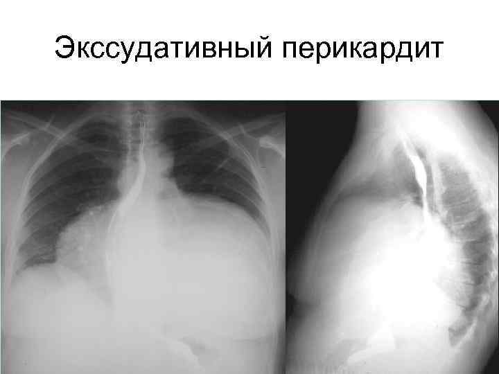 Экссудативный перикардит 