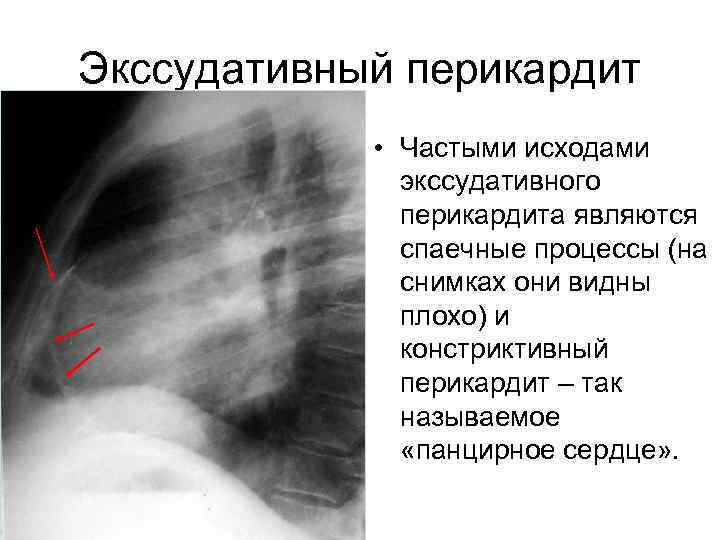 Экссудативный перикардит • Частыми исходами экссудативного перикардита являются спаечные процессы (на снимках они видны