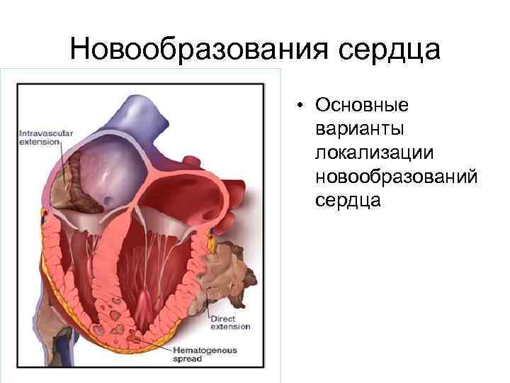 Новообразования сердца • Основные варианты локализации новообразований сердца 