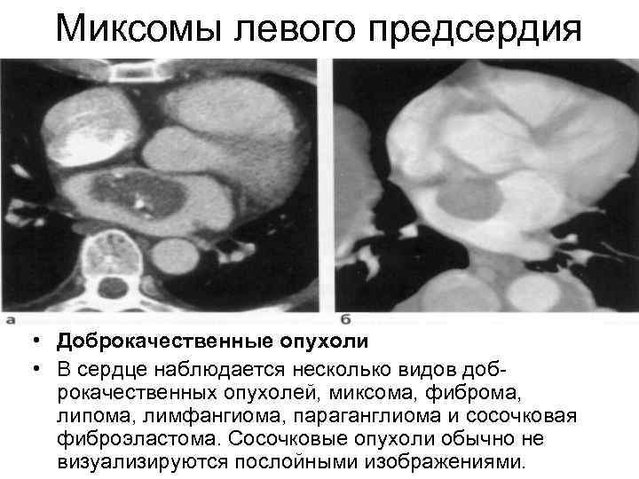 Миксомы левого предсердия • Доброкачественные опухоли • В сердце наблюдается несколько видов доброкачественных опухолей,
