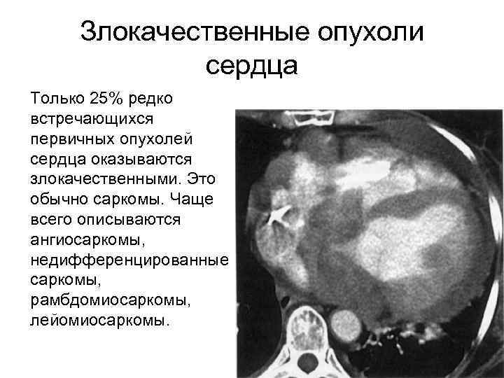 Злокачественные опухоли сердца Только 25% редко встречающихся первичных опухолей сердца оказываются злокачественными. Это обычно