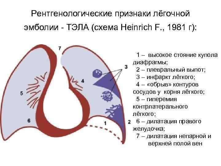 Рентгенологические признаки лёгочной эмболии - ТЭЛА (схема Heinrich F. , 1981 г): 1 –