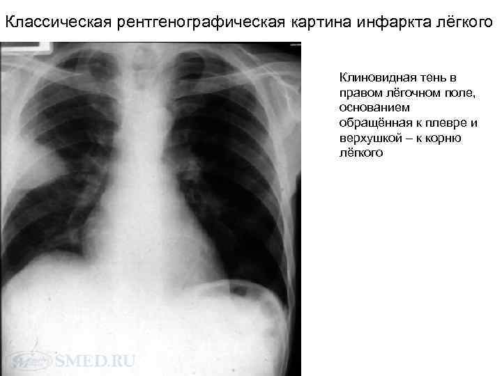 Классическая рентгенографическая картина инфаркта лёгкого Клиновидная тень в правом лёгочном поле, основанием обращённая к