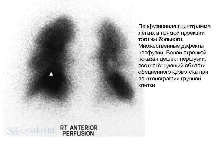 Перфузионная сцинтграмма лёгких в прямой проекции того же больного. Множественные дефекты перфузии. Белой стрелкой