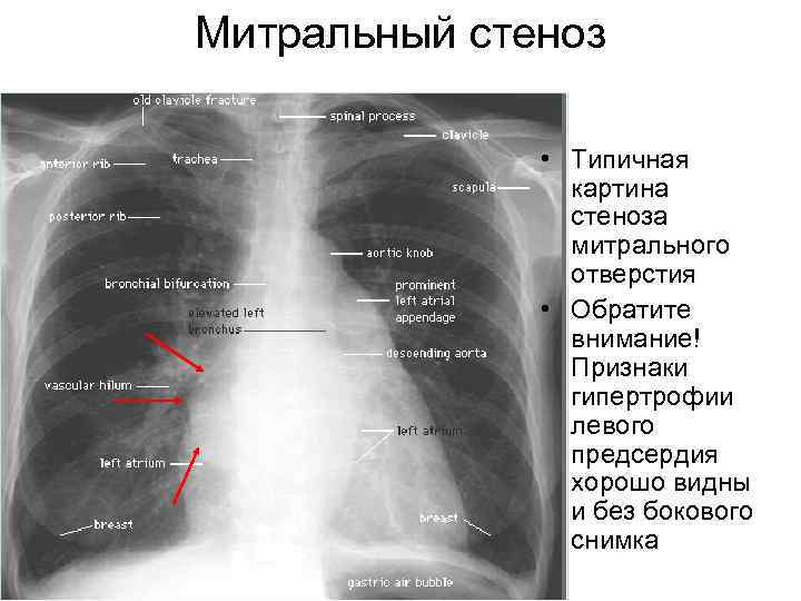 Митральный стеноз • Типичная картина стеноза митрального отверстия • Обратите внимание! Признаки гипертрофии левого