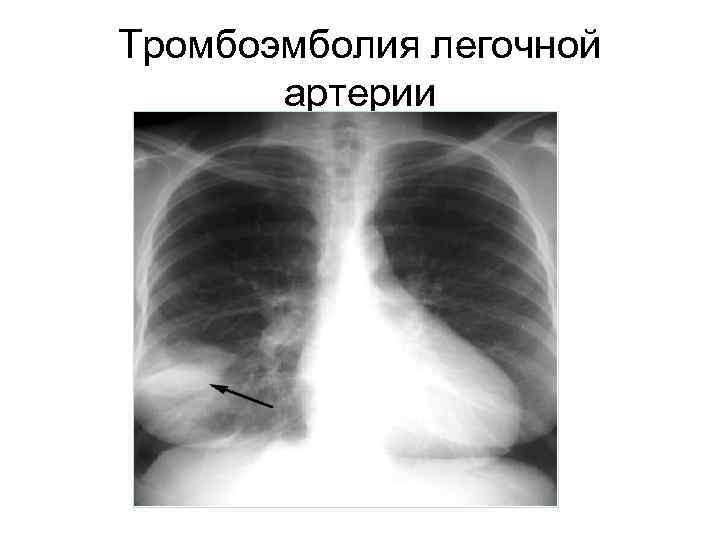 Тромбоэмболия легочной артерии 