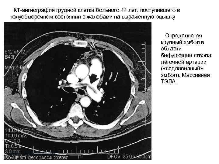  КТ-ангиография грудной клетки больного 44 лет, поступившего в полуобморочном состоянии с жалобами на