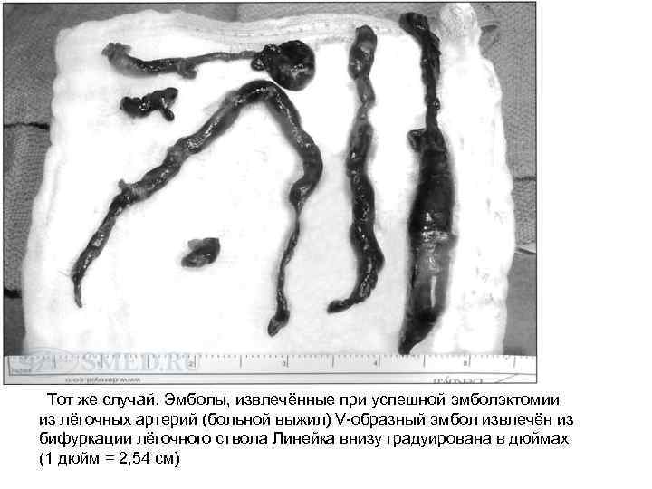 Тот же случай. Эмболы, извлечённые при успешной эмболэктомии из лёгочных артерий (больной выжил) V-образный
