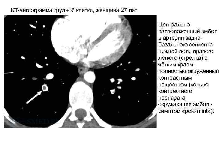  КТ-ангиограмма грудной клетки, женщина 27 лет Центрально расположенный эмбол в артерии заднебазального сегмента
