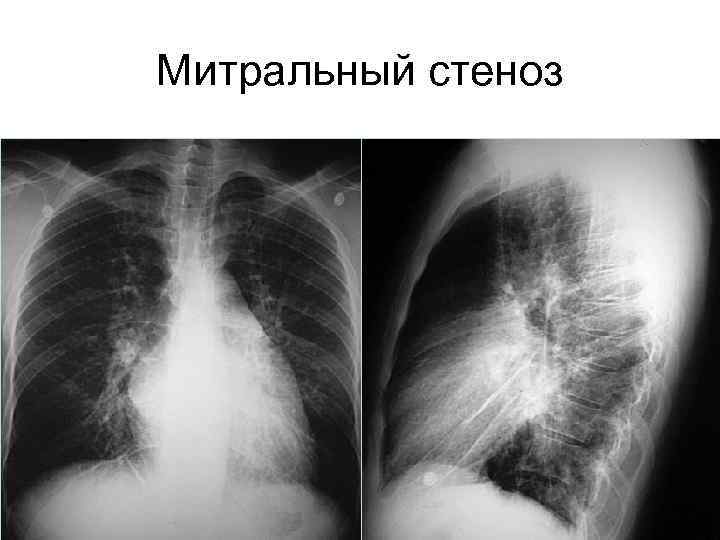 Митральный стеноз 