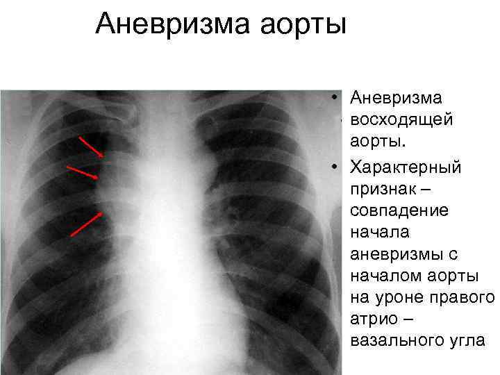Аневризма аорты • Аневризма восходящей аорты. • Характерный признак – совпадение начала аневризмы с