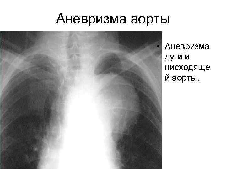 Аневризма аорты • Аневризма дуги и нисходяще й аорты. 