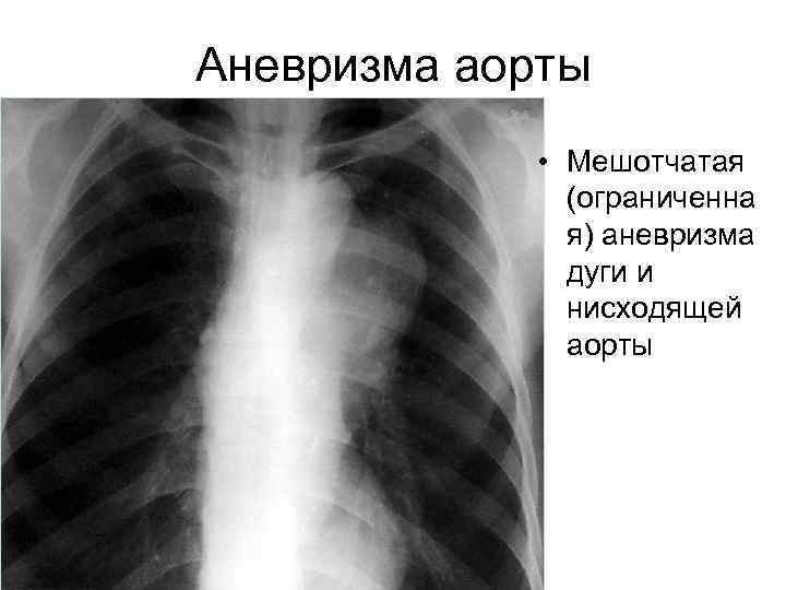 Аневризма аорты • Мешотчатая (ограниченна я) аневризма дуги и нисходящей аорты 