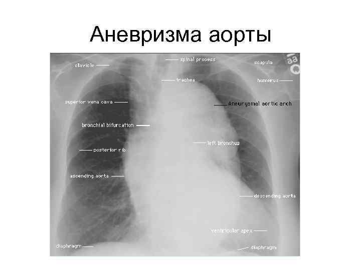 Аневризма аорты 
