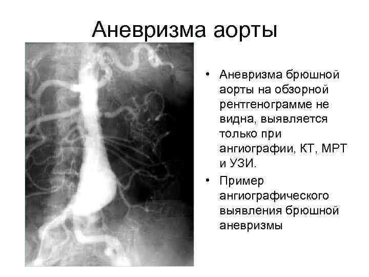 Аневризма аорты • Аневризма брюшной аорты на обзорной рентгенограмме не видна, выявляется только при