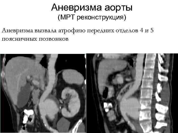 Аневризма аорты (МРТ реконструкция) Аневризма вызвала атрофию передних отделов 4 и 5 поясничных позвонков