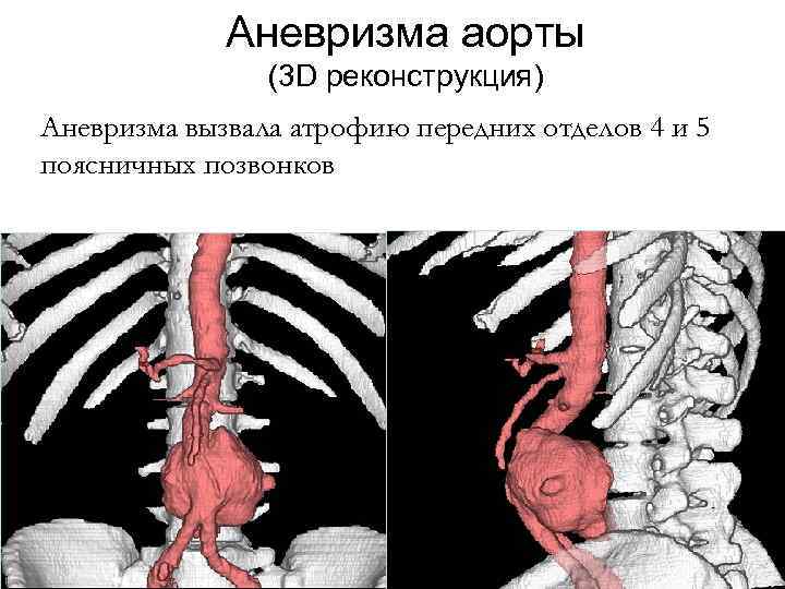 Аневризма аорты (3 D реконструкция) Аневризма вызвала атрофию передних отделов 4 и 5 поясничных
