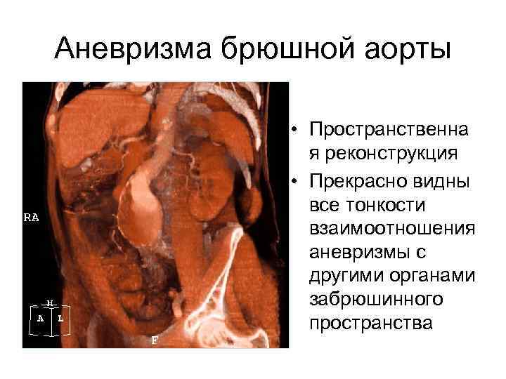 Аневризма брюшной аорты • Пространственна я реконструкция • Прекрасно видны все тонкости взаимоотношения аневризмы