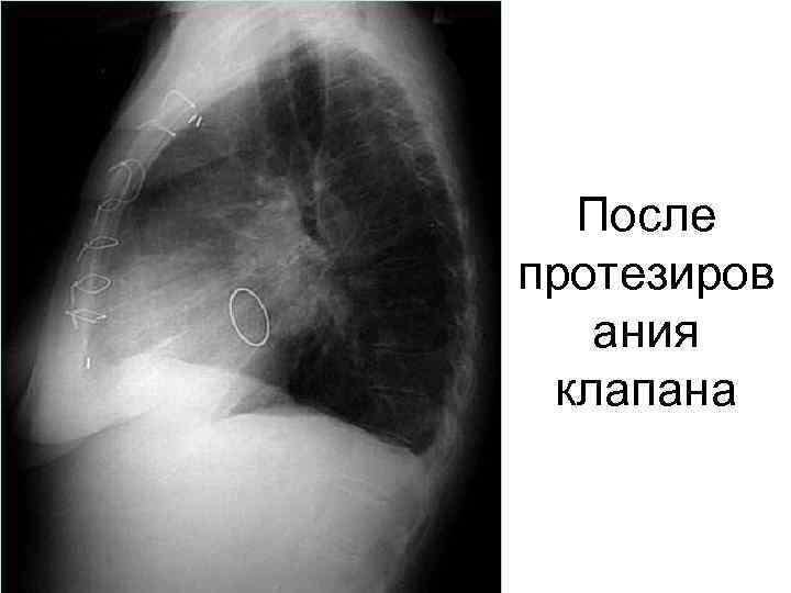 После протезиров ания клапана 