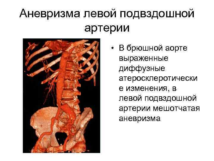 Аневризма левой подвздошной артерии • В брюшной аорте выраженные диффузные атеросклеротически е изменения, в