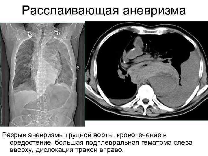 Расслаивающая аневризма Разрыв аневризмы грудной аорты, кровотечение в средостение, большая подплевральная гематома слева вверху,