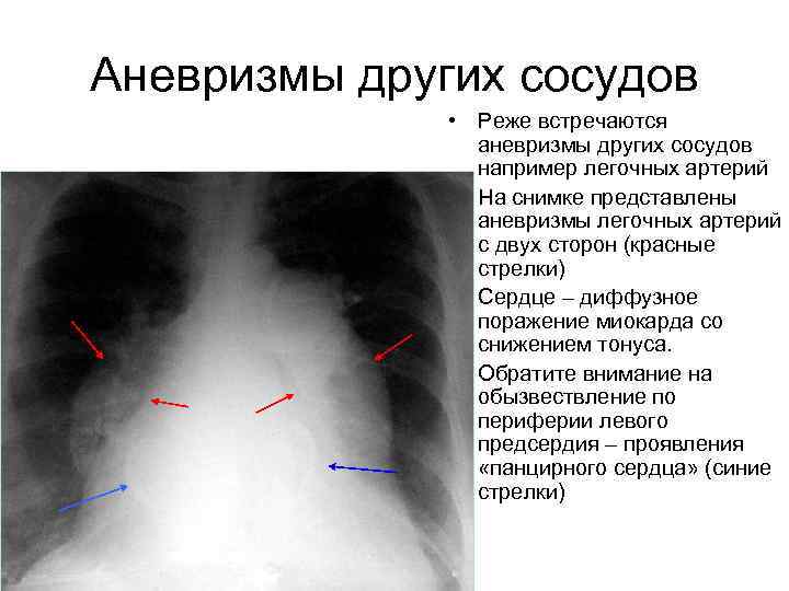 Аневризмы других сосудов • Реже встречаются аневризмы других сосудов например легочных артерий • На