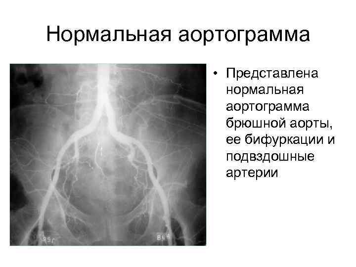 Нормальная аортограмма • Представлена нормальная аортограмма брюшной аорты, ее бифуркации и подвздошные артерии 
