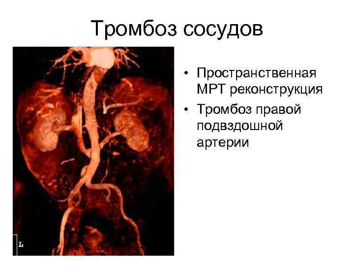 Тромбоз сосудов • Пространственная МРТ реконструкция • Тромбоз правой подвздошной артерии 