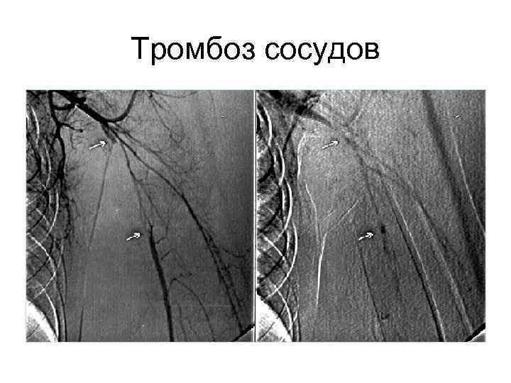 Тромбоз сосудов 