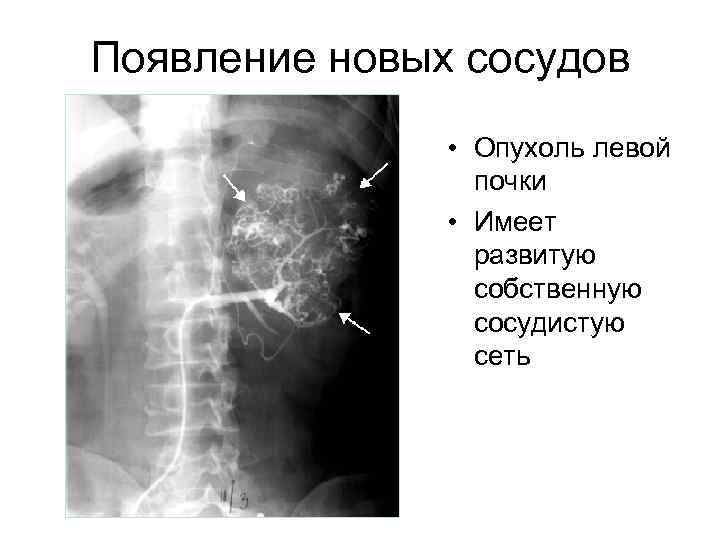 Появление новых сосудов • Опухоль левой почки • Имеет развитую собственную сосудистую сеть 
