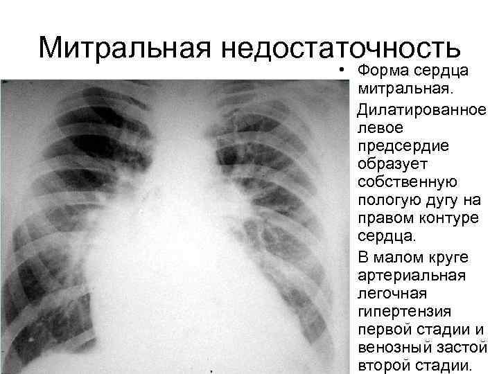 Митральная недостаточность • Форма сердца митральная. Дилатированное левое предсердие образует собственную пологую дугу на