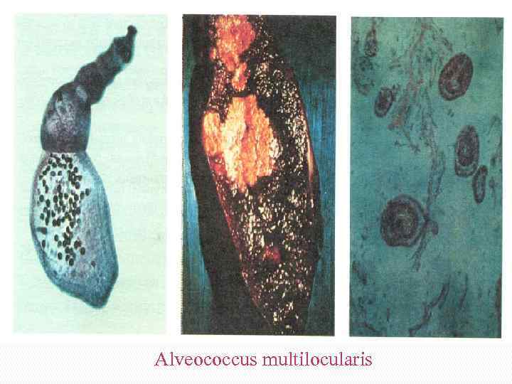 Alveococcus multilocularis 