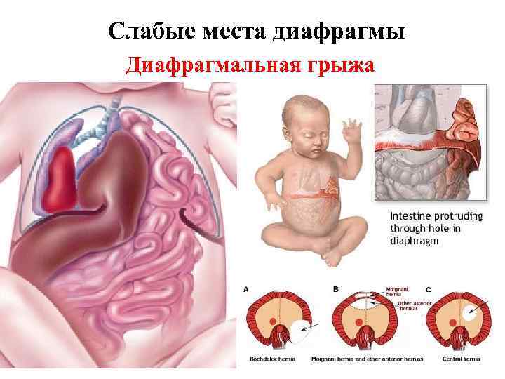 Слабые места диафрагмы Диафрагмальная грыжа 