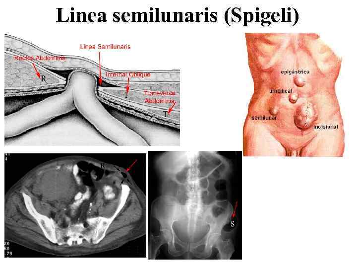 Linea semilunaris (Spigeli) 