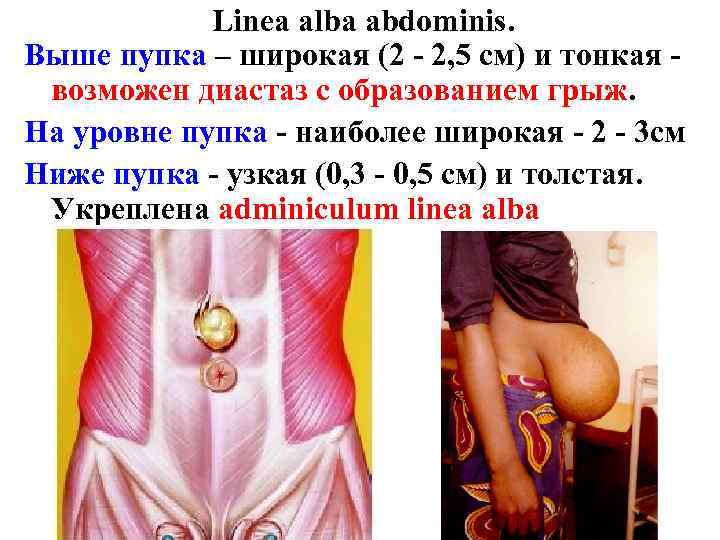 Linea alba abdominis. Выше пупка – широкая (2 - 2, 5 см) и тонкая