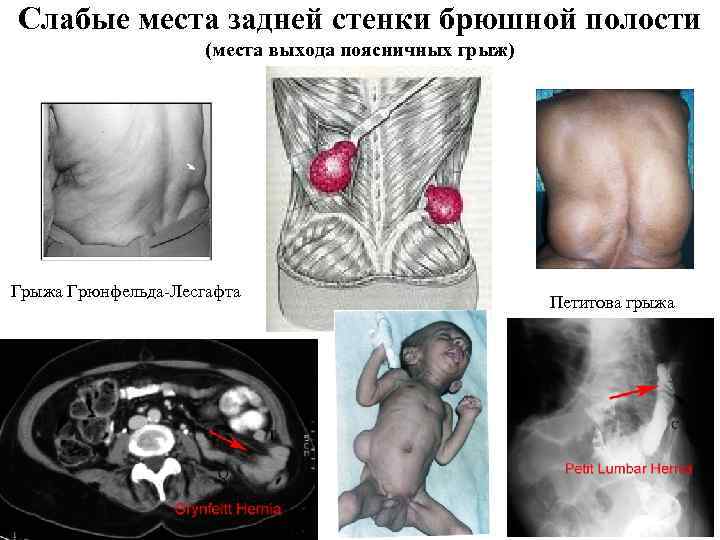 Слабые места задней стенки брюшной полости (места выхода поясничных грыж) Грыжа Грюнфельда-Лесгафта Петитова грыжа