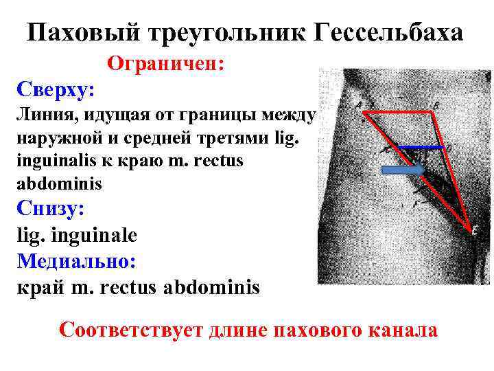 Паховый треугольник Гессельбаха Ограничен: Сверху: Линия, идущая от границы между наружной и средней третями