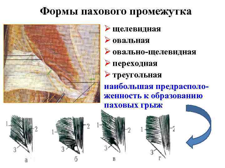 Формы пахового промежутка Ø щелевидная Ø овально-щелевидная Ø переходная Ø треугольная наибольшая предрасположенность к