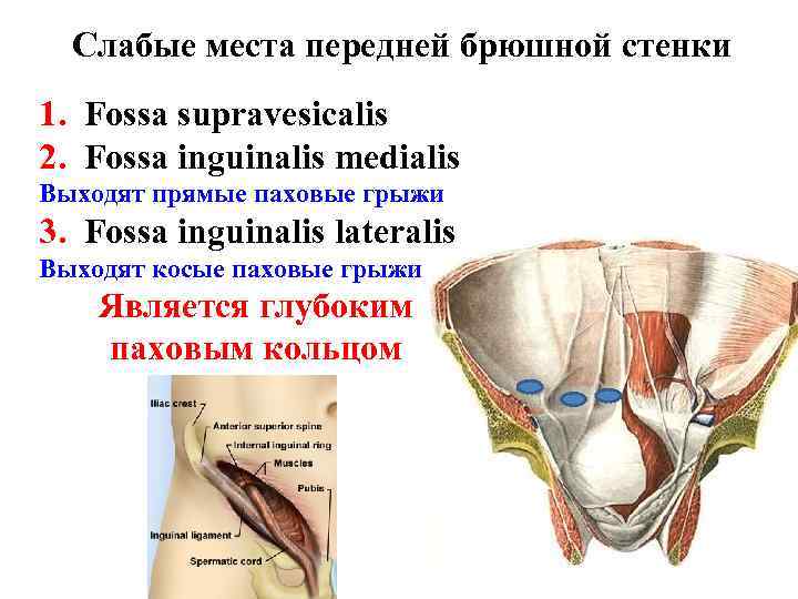 Слабые места передней брюшной стенки 1. Fossa supravesicalis 2. Fossa inguinalis medialis Выходят прямые