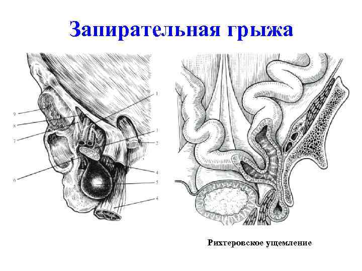 Запирательная грыжа Рихтеровское ущемление 