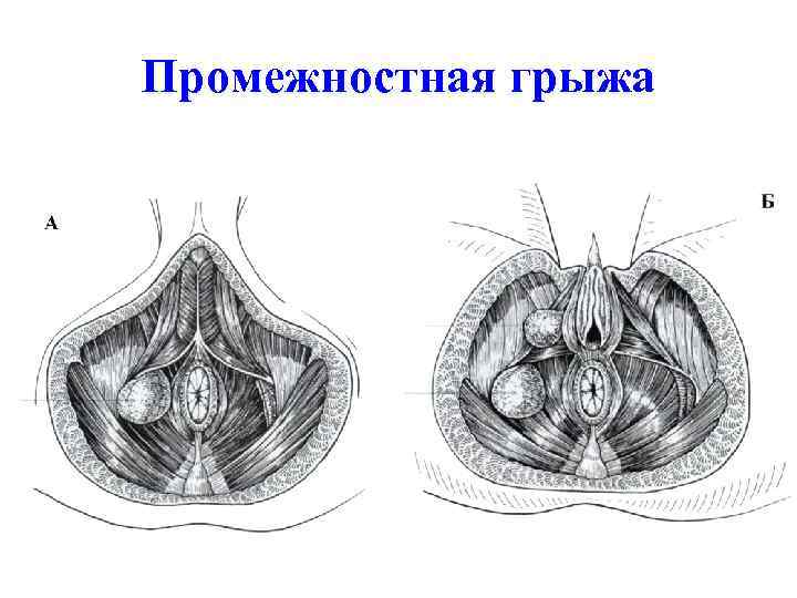 Промежностная грыжа 