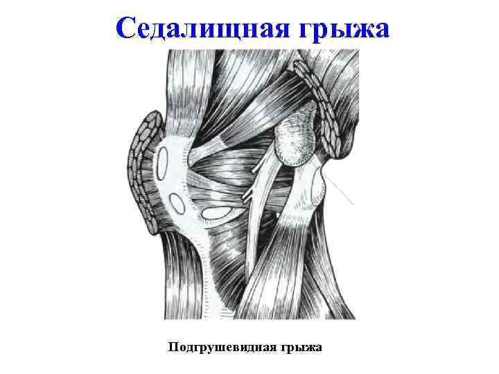 Седалищная грыжа Подгрушевидная грыжа 