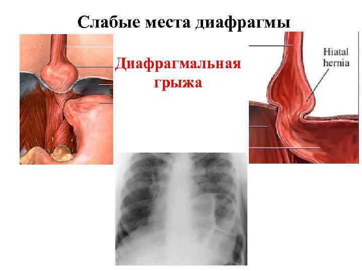 Слабые места диафрагмы Диафрагмальная грыжа 