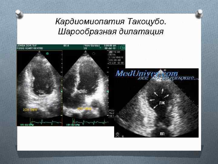 Кардиомиопатия Такоцубо. Шарообразная дилатация 